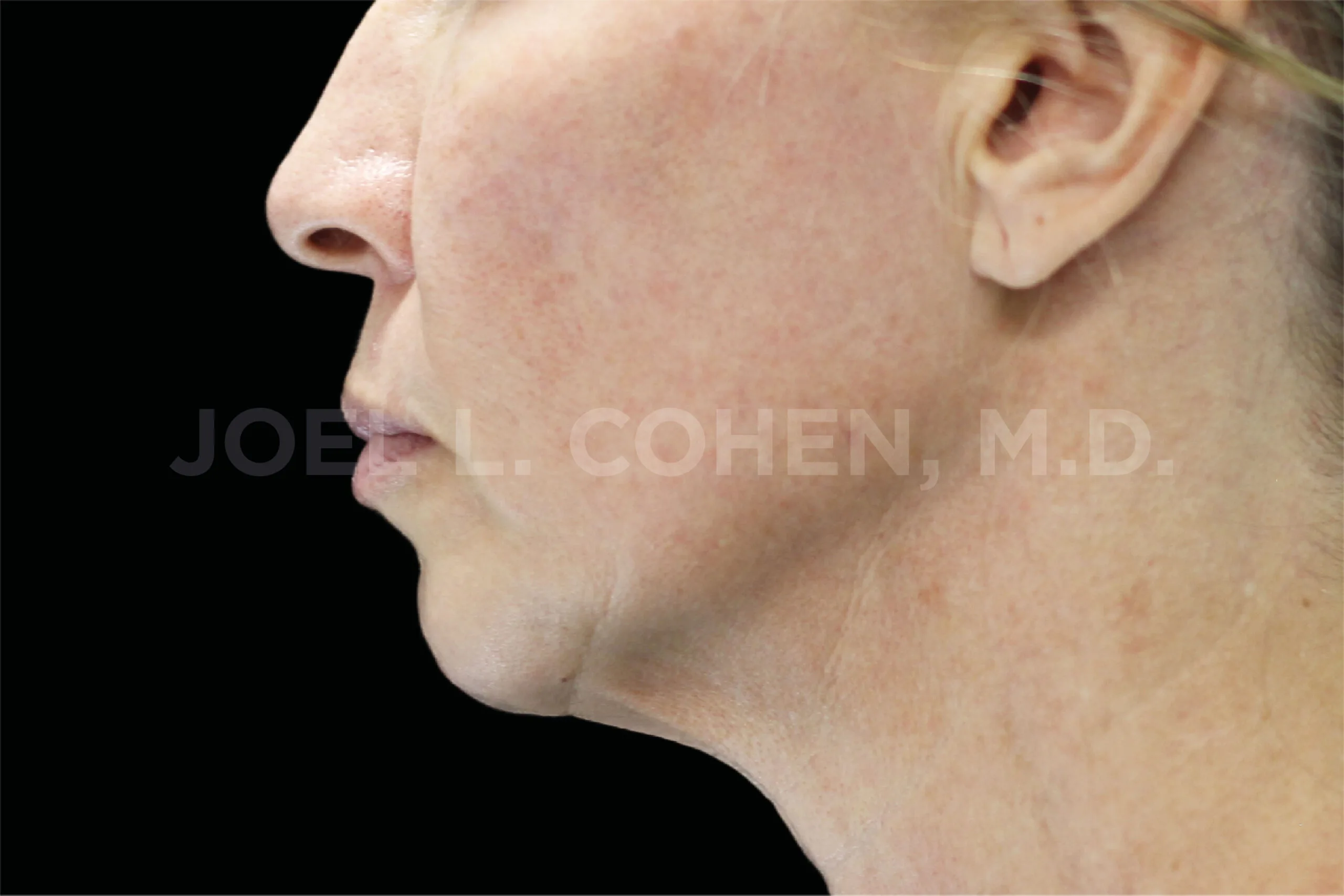 Jawline and neck in profile after EMface facial toning at our Amsterdam clinic