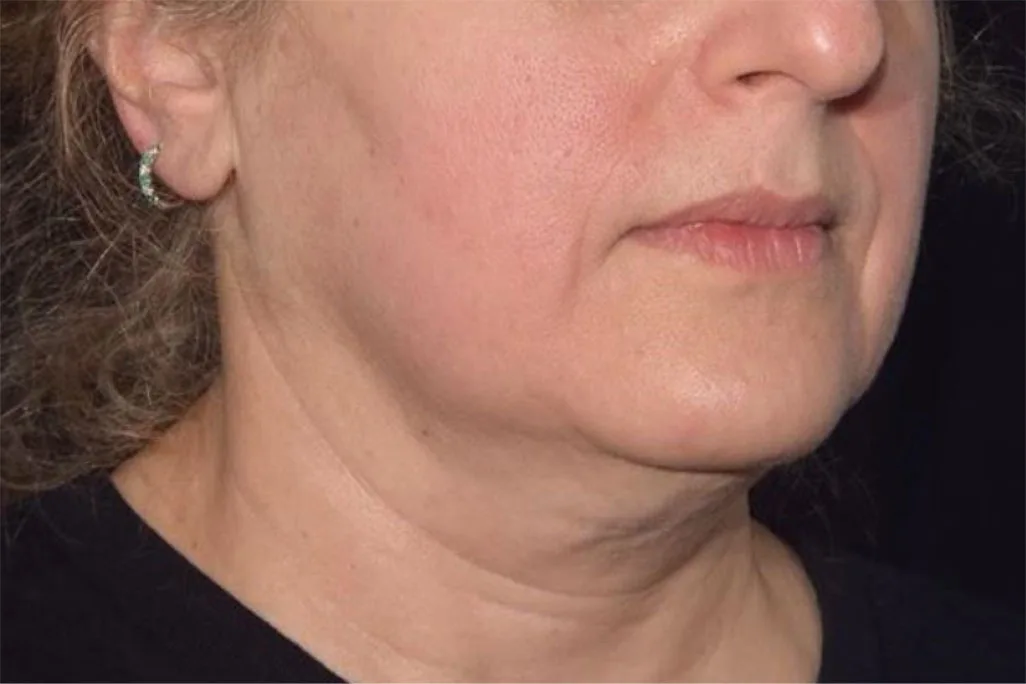Jawline and neck after EMface facial toning at our Amsterdam clinic