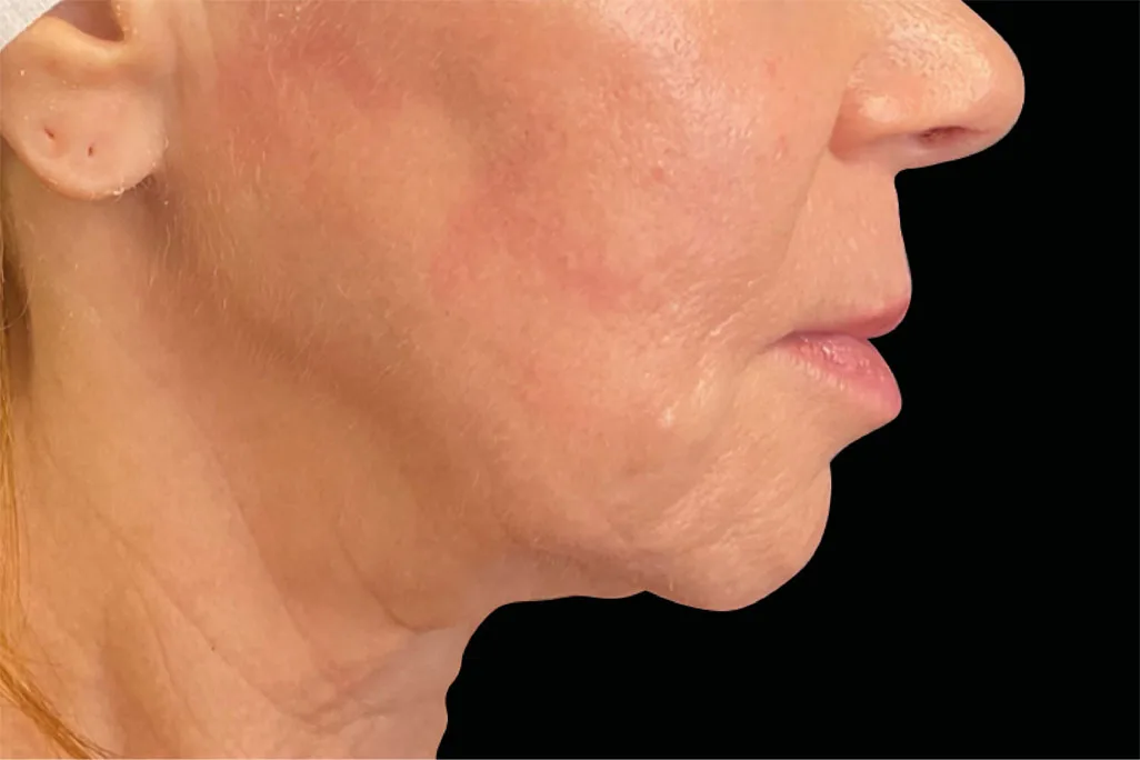 Neck in profile after EMface facial toning at our Amsterdam clinic