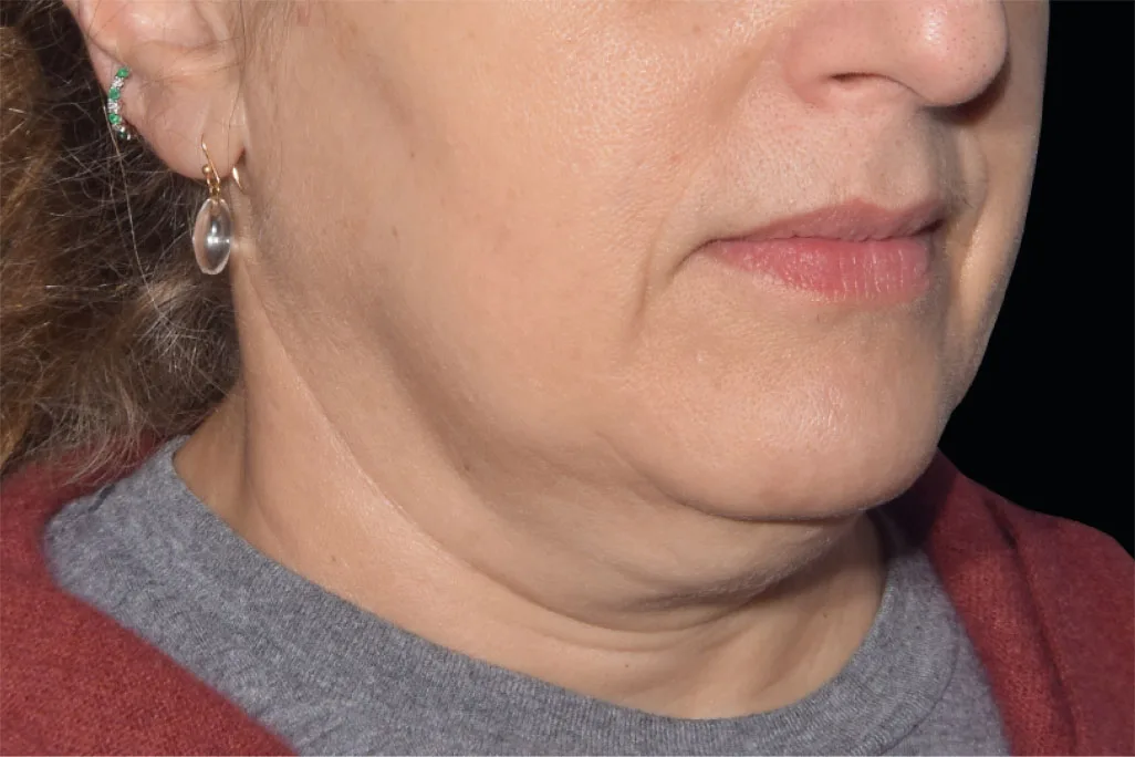 Jawline and neck before EMface facial toning at our Amsterdam clinic