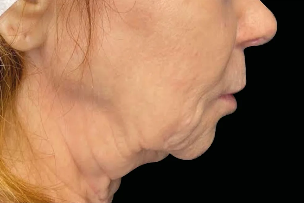 Neck in profile before EMface facial toning at our Amsterdam clinic