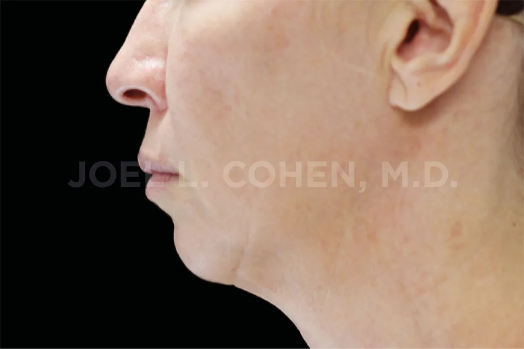 Jawline and neck in profile before EMface facial toning at our Amsterdam clinic